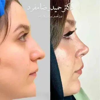 befor-after-rhinoplasty-dr-hamidreza-mofrad-4