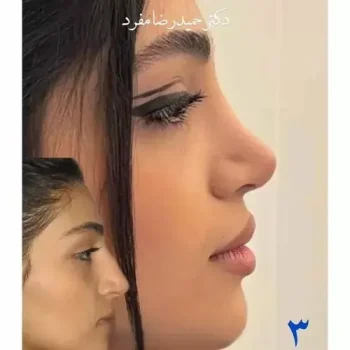 نمونه عمل بینی دکتر مفرد تهران