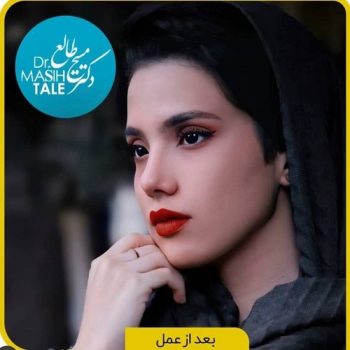 نمونه کار دکتر طالع در شیراز با مشاوره زیباکس