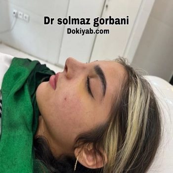 نمونه جراحی بینی دکتر سولماز قربانی در شیراز با مشاوره زیباکس