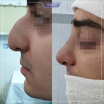 تصویر قبل و بعد جراحی زیبایی بینی دکتر ده بزرگی شیراز