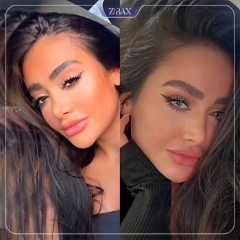 جراحی زییایی بینی توسط دکتر ده بزرگی شیراز