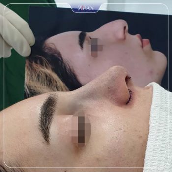 تصویر قبل و بعد عمل زیبایی بینی توسط دکتر محمد مهدی ده بزرگی شیراز