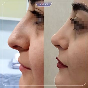 نمونه جراحی بینی دکتر محمد مهدی ده بزرگی در شیراز