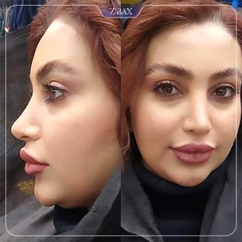 نمونه کار جراحی بینی دکتر ده بزرگی شیراز