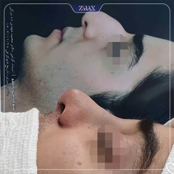 عکس جراحی زیبایی بینی دکتر ده بزرگی شیراز