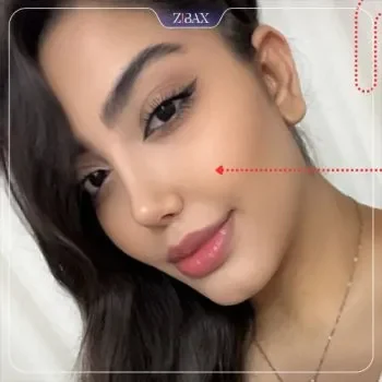 نمونه کار دکتر محمدی مفرد جراح بینی