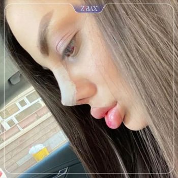 تصویر عمل زیبایی بینی با دکتر احسان شفیعی در تهران