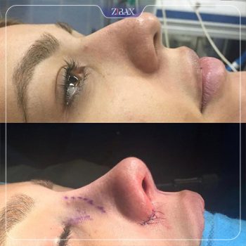 نمونه جراحی بینی با دکتر حمیدرضا نوری جراح بینی در تهران