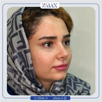 نمونه کار دکتر صباغی بینی طبیعی