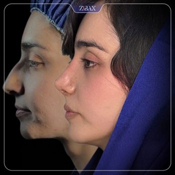 عکس نمونه کار جراحی بینی با دکتر فرهاد محرابی یاسوج