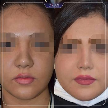 نمونه جراحی زیبایی بینی دکتر فیروزه یگانه در شیراز
