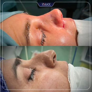 نمونه جراحی زیبایی بینی با دکتر فیروزه یگانه