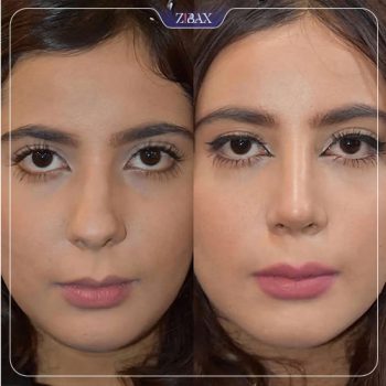 نمونه کار عمل زیبایی بینی با دکتر فیروزه یگانه در شیراز