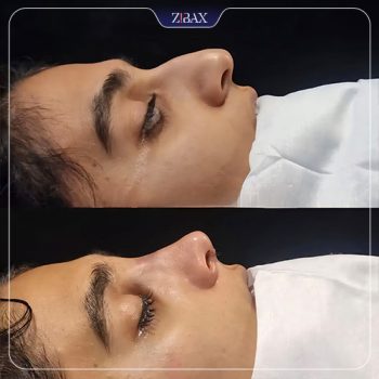 تصویر قبل و بعد جراحی زیبایی بینی دکتر لیلا شریفی