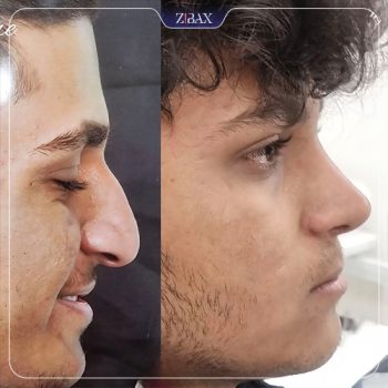 عکس قبل و بعد جراحی زیبایی بینی دکتر لیلا شریفی