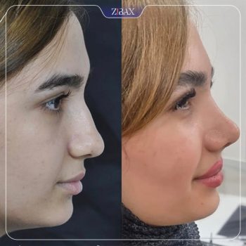 نمونه کار جراحی بینی با دکتر لیلا شریفی شیراز