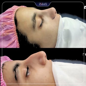 عکس نمونه عمل بینی توسط دکتر لیلا شریفی در شیراز