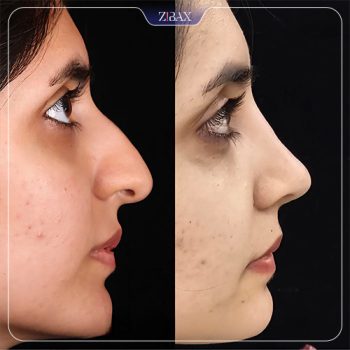 تصویر نمونه کار عمل بینی توسط دکتر لیلا شریفی در شیراز