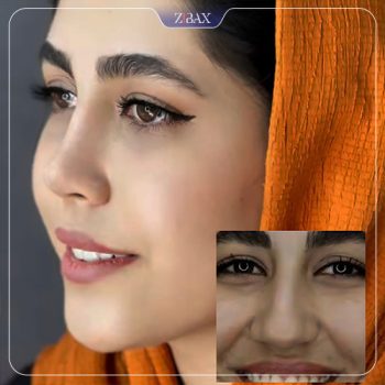 نمونه جراحی بینی دکتر لطفعلی نوروزی در شیراز