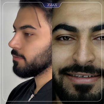 عمل زیبایی بینی با دکتر لطفعلی نوروزی در شیراز