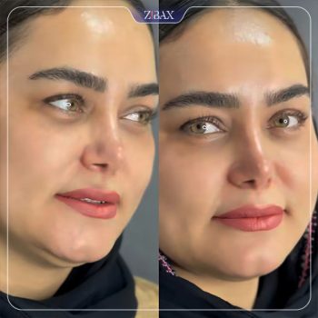 جراحی زیبایی بینی دکتر لطفعلی نوروزی در شیراز