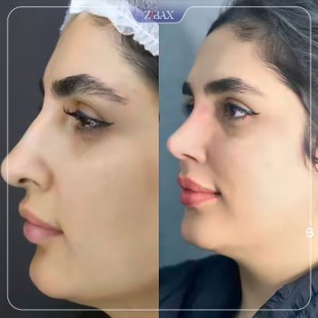 عکس قبل و بعد عمل بینی با دکتر لطفعلی نوروزی در شیراز