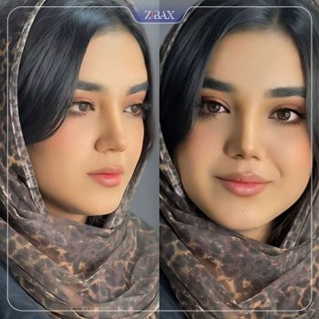 نمونه کار جراحی بینی دکتر لطفعلی نورورزی شیراز