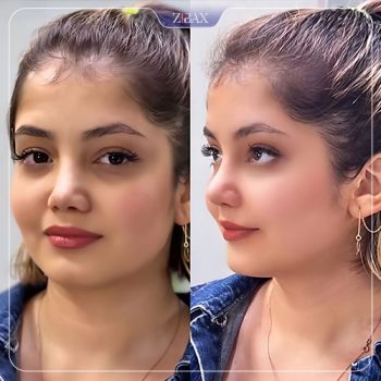 عکس عمل بینی توسط دکتر لطفعلی نوروزی در شیراز