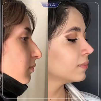 قبل و بعد عمل بینی توسط دکتر لطفعلی نوروزی