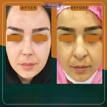 نمونه کار دکتر گندمی جراح بینی شیراز