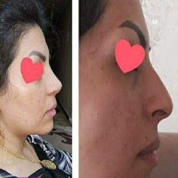 نمونه عمل بینی دکتر شهریار شاهمرادی در شیراز با مشاره زیباکس