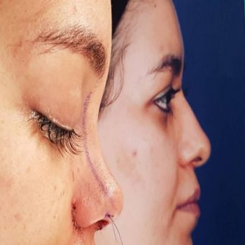 نمونه کار دکتر شاهمرادی جراح بینی در شیراز با مشاوره زیباکس