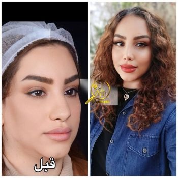 نمونه عمل بینی دکتر سولماز قربانی در شیراز با مشاوره زیباکس