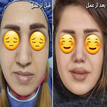 نمونه کار دکتر حسین کرم نژاد جراح بینی در شیراز با مشاوره زیباکس