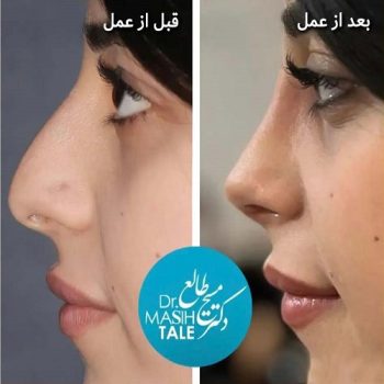 نمونه عمل بینی دکتر مسیح طالع جراح بینی در شیراز با مشاوره زیباکس