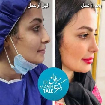 نمونه کار دکتر مسیح طالع جراح بینی در شیراز با مشاوره زیباکس