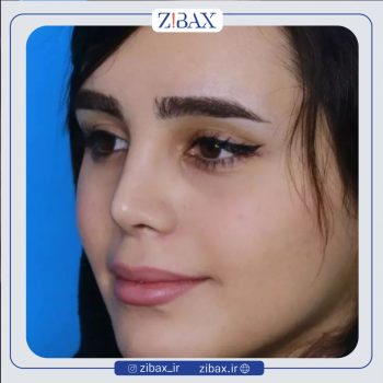 نمونه کار عمل بینی با دکتر مریم بحری جراح زیبایی بینی تهران