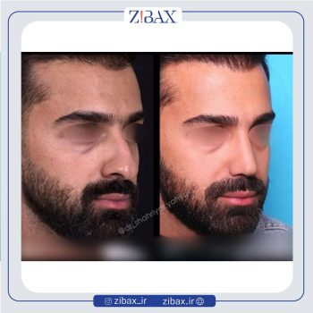 جراحی بینی مردانه با دکتر شهریار یحیوی
