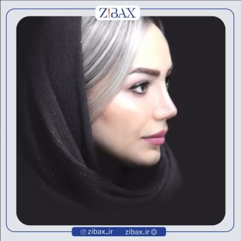 عمل راینوپلاستی بینی با دکتر احمد زمانیان