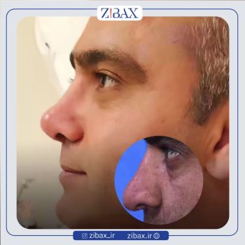 نمونه جراحی بینی مردانه با دکتر نفیسه خلیلی