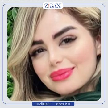 عمل راینوپلاستی بینی با دکتر نفیسه خلیلی
