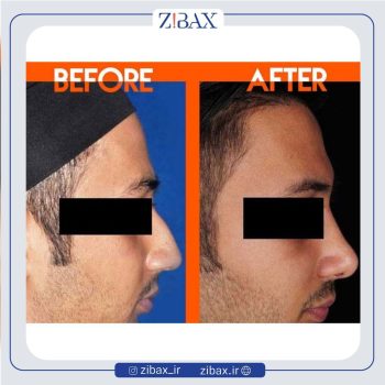 نمونه عمل بینی با دکتر محمدرضا توکلی