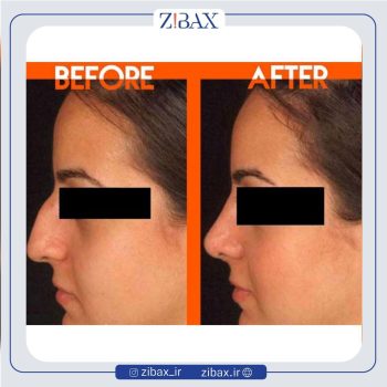 عمل بینی دخترانه با دکتر محمدرضا توکلی