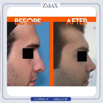 جراحی طبیعی بینی مردانه با دکتر محمدرضا توکلی