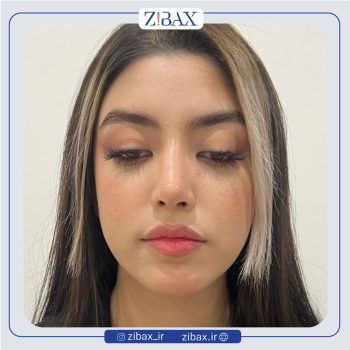 نمونه کار جراحی بینی با دکتر پیام حق پناه جراح بینی شیراز