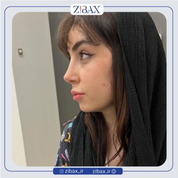 نمونه کار عمل بینی با دکتر پیام حق پناه جراح بینی شیراز