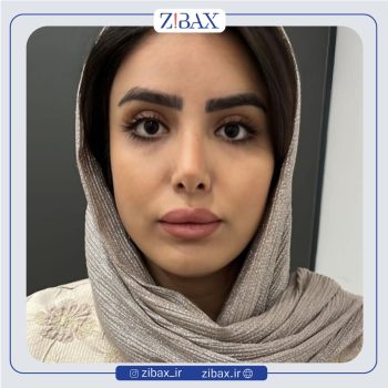نمونه کار جراحی دماغ با دکتر پیام حق پناه جراح بینی شیراز