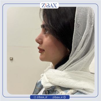 نمونه جراحی بینی با دکتر پیام حق پناه جراح بینی شیراز