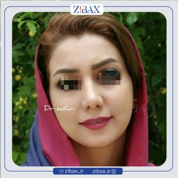 جراحی زیبایی بینی دکتر محمد صفری